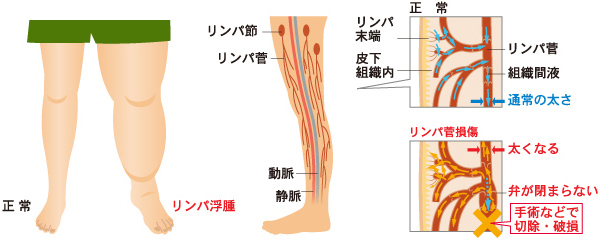 リンパ浮腫